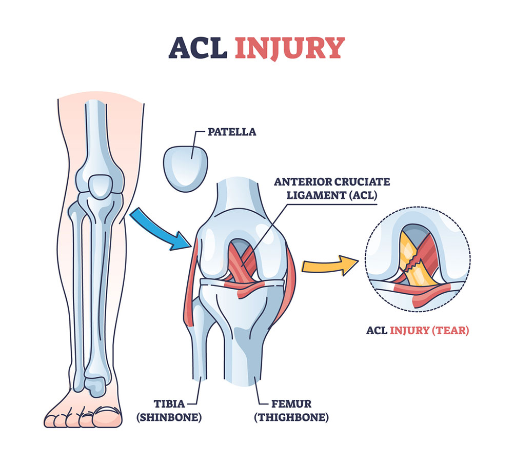 Anatomy diagram showing the ACL connecting the femur to the tibia inside the knee joint