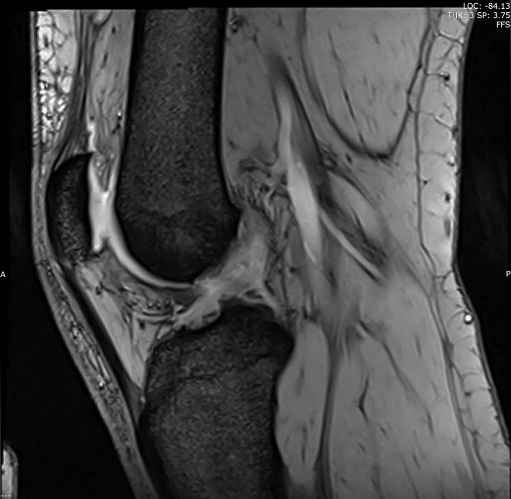 Anatomy diagram showing the medial collateral ligament on the inner knee with direction of force causing MCL injury